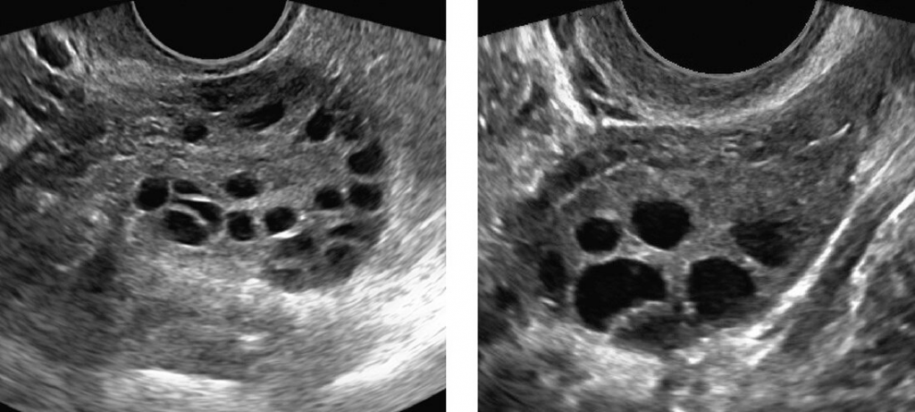 Do I Have Polycystic Ovaries 