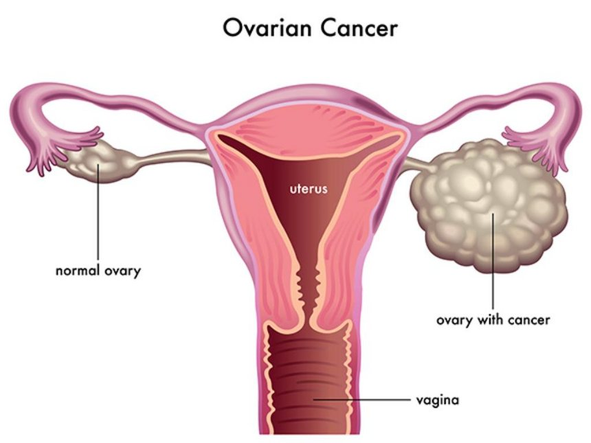 Do I Have Polycystic Ovaries 